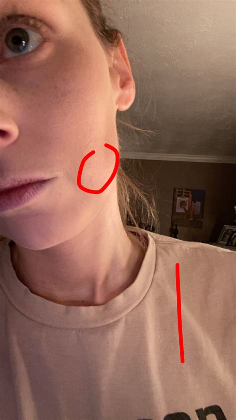 Little lump leftover from nodule? – Hormonal acne – Acne.org Forum