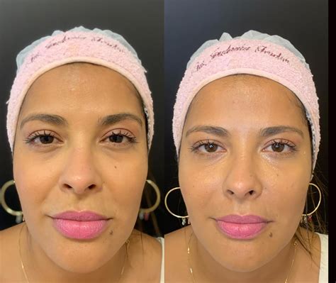 Botox Bigode Chines Antes E Depois - Bigode Chines Antes E Depois Do Preenchimento - NAZAEDU