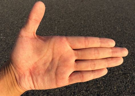 simple home remedies  cracked hands