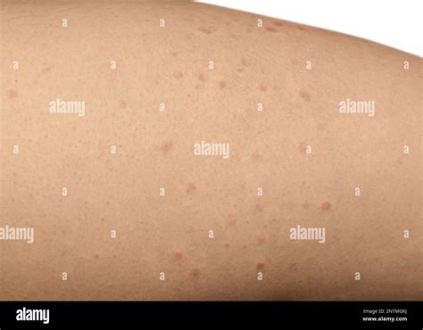 burns from laser hair removal. Burn spots from laser skin treatment for ...