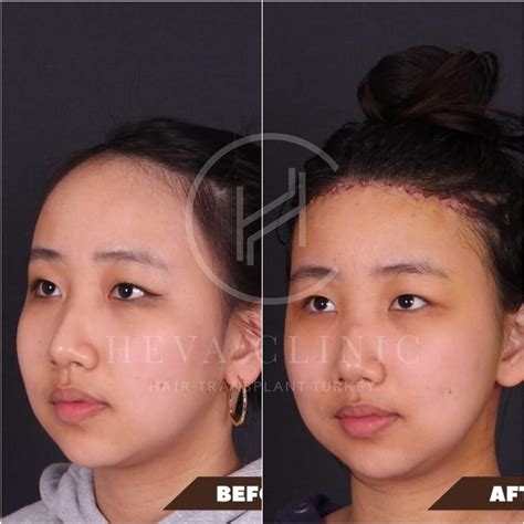 Forehead Reduction (Hairline Lowering) in Turkey - Costs in 2026 - Heva