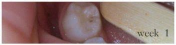 More Photographic Proof Cavities Heal | Healthy Home Economist