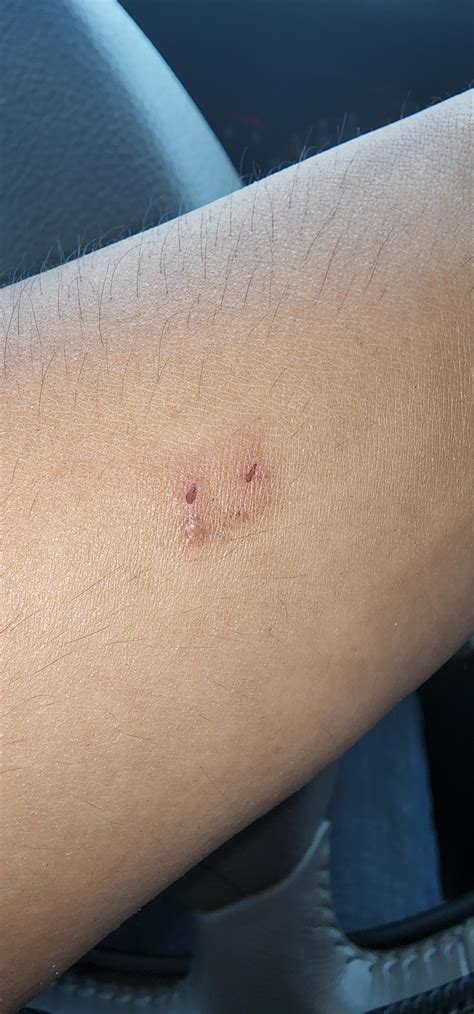 Bat Bite Statistics at Karen Evans blog