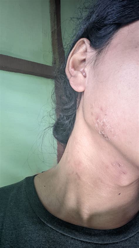 kulit bagian wajah terasa gatal hellosehat