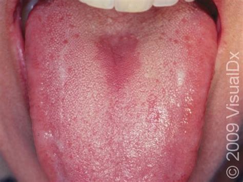 Oral Candidiasis (Thrush): Symptoms, Treatment, and Prevention