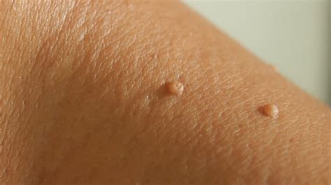 symptoms prevention treatment    skin tags