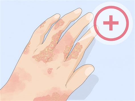 8 Ways to Use Aloe Vera to Treat Eczema - wikiHow