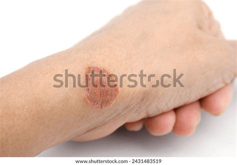 Microsporum Canis Lesion Fungus Infections On Stock Photo 2431483519 ...