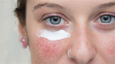 Treating rosacea on the face | Spot Check: skin cancer + aesthetics
