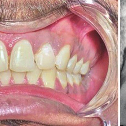 intracoronal bleaching    month radiograph showing