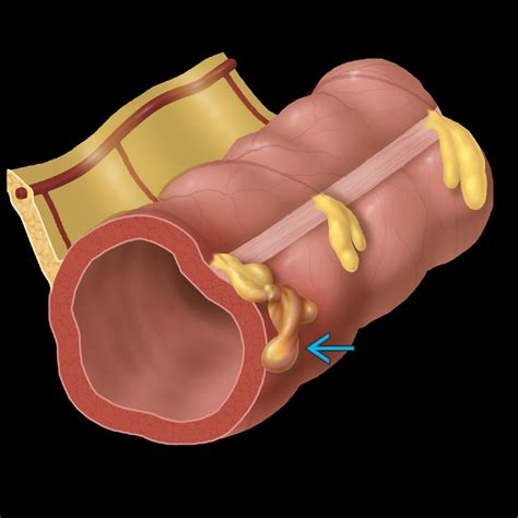 epiploic appendagitis radiology key