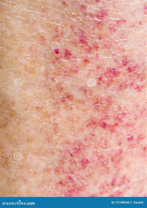 Sun Adverse Reaction, Allergy, Red Rash On Legs. Royalty-Free Stock