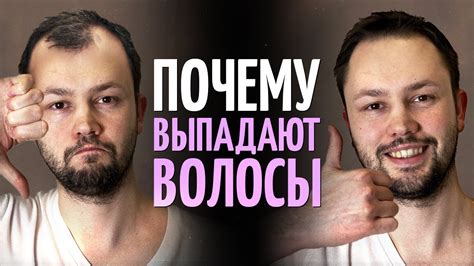 Почему выпадают волосы? Врач косметолог о причинах облысения. - YouTube