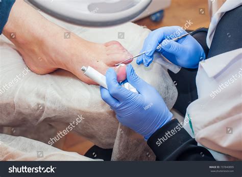 1,154 Toe Nail Surgery Images, Stock Photos & Vectors | Shutterstock