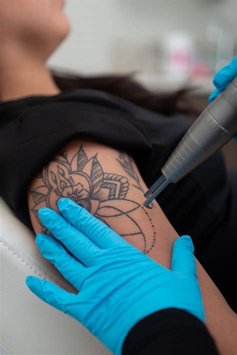 tattoo removal face 12