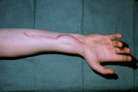 VOLKMANN'S CONTRACTURE | Hand Surgery Resource