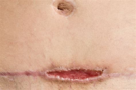 Wound Dehiscence: Causes and Treatment Options | Shield HealthCare