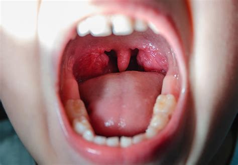 faringitis virica como tratarla mejor  salud