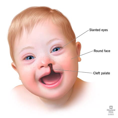 Double Trisomy