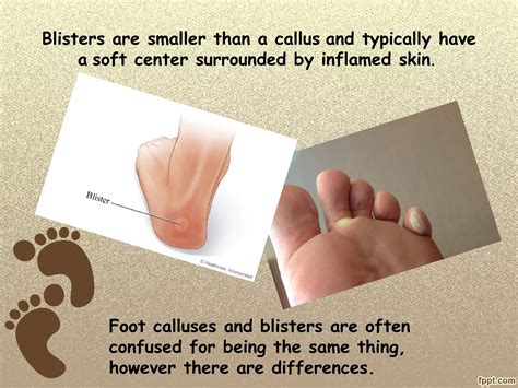 Foot corns, calluses & blister treatment | PPT