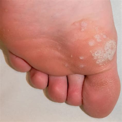 What Are Mosaic Warts? | Podiatry & Foot and Ankle Surgery located in ...