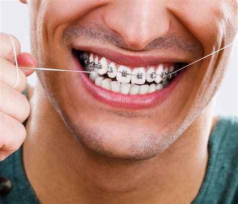 lorthodontie pour adulte audi dental clinic