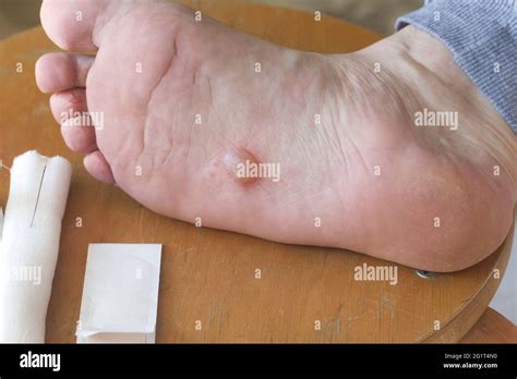 Dyshidrotic eczema hi-res stock photography and images - Alamy