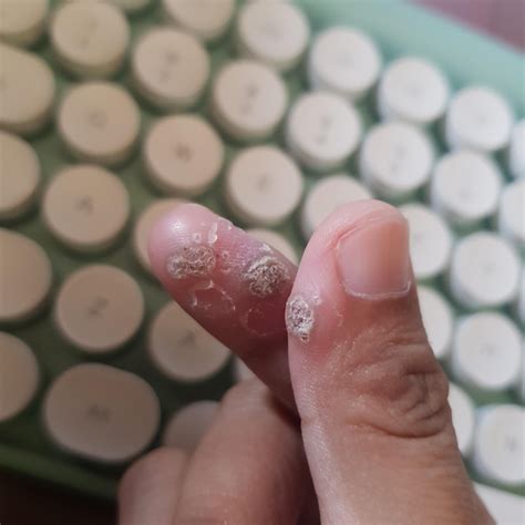 How are you helping your immune system? : r/Warts