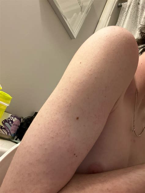 is this Keratosis pilaris? : r/keratosis