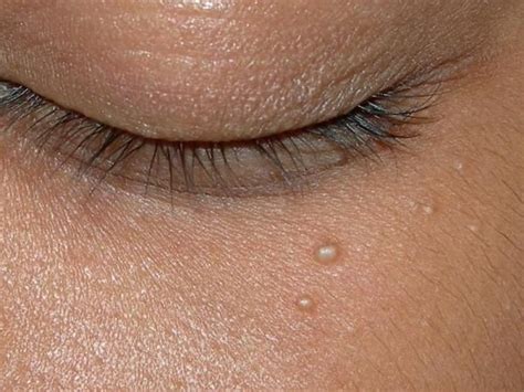 comment enlever les grains de milium decouvrez ici comment enlever