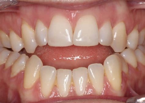 orthodontic treatment    open bite orthodontix