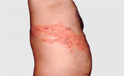 Arm Dermatomes Shingles at Linda Aucoin blog