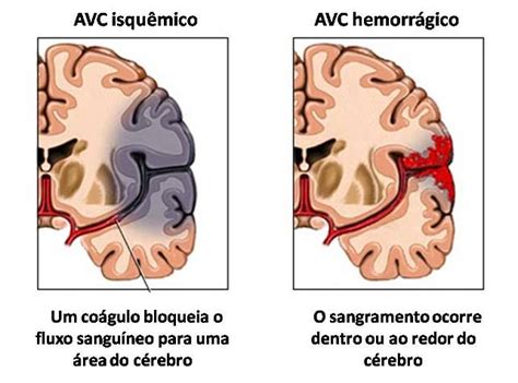 O Que Causa Acidente Vascular Cerebral - Sinais e sintomas de um Acidente Vascular Cerebral (AVC) - Physioclem