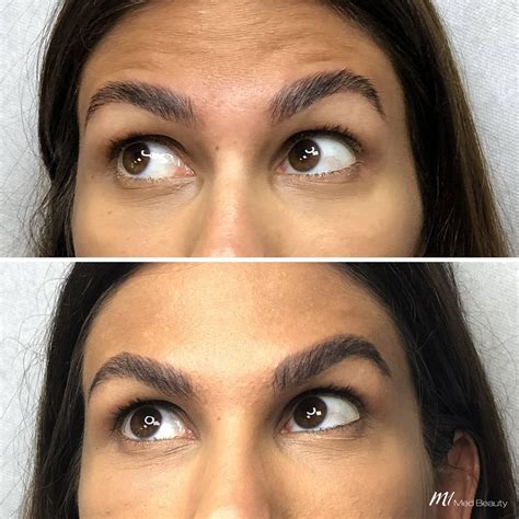 Before and After treatment pictures - M1 Med Beauty BG