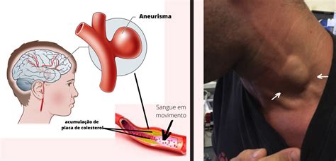 O Que É Aneurisma No Coração - O que é aneurisma: sintomas, causas e tipos