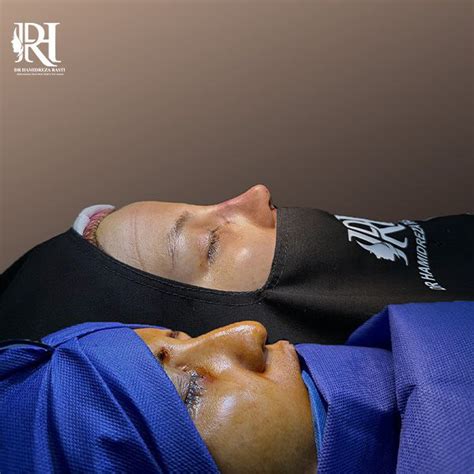 types  nose surgery  nose surgery methods dr hamidreza rasti