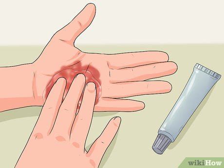 Queimadura No Dedo O Que Fazer - 4 Formas de Tratar uma Queimadura nas Mãos - wikiHow