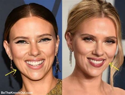 scarlett johansson plastic surgery comparison