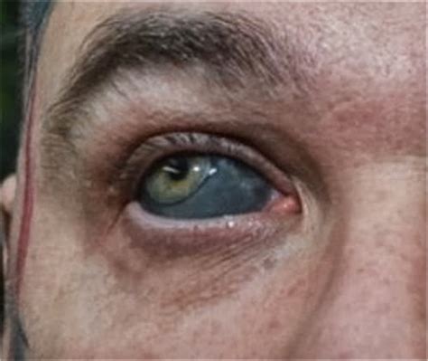 Deformutilation: Sclera Tattoos Part III