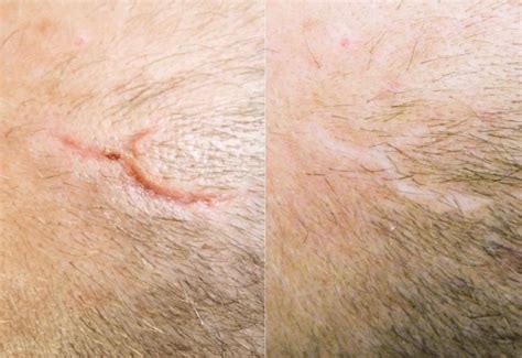 scar removal surgery  surgical scar removal australia cutis clinic