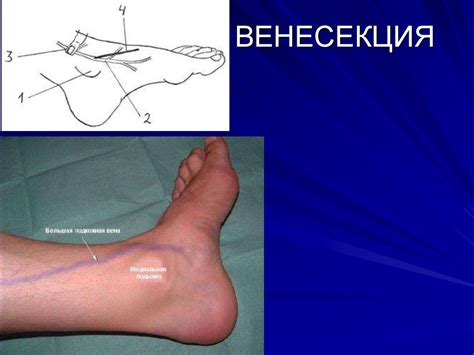Временные способы остановки кровотечения - презентация онлайн