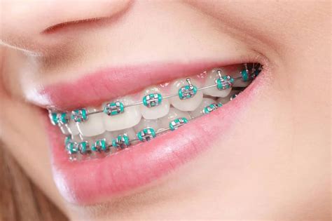 braces cyberjaya karimah dental