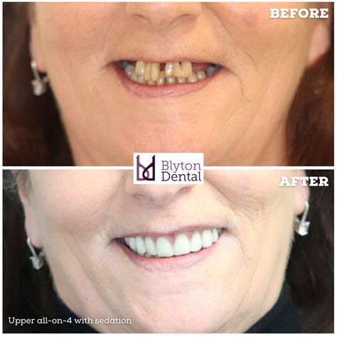 Upper all-on-4 with sedation — Blyton Dental
