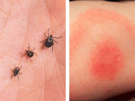 Lyme Disease – Know the Signs - Conservation Federation of Missouri
