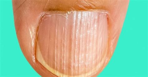 Unha Com Riscos Verticais - Unhas Com Estrias Verticais - RETOEDU