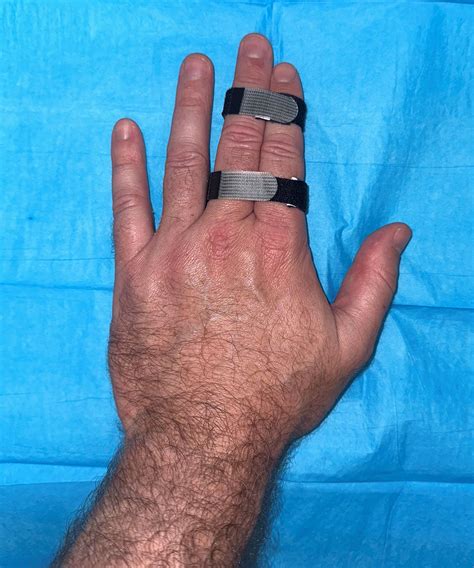 finger sprains orthoinfo aaos