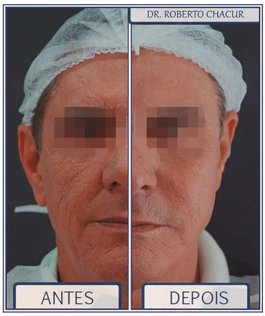 Goldincision Antes E Depois - GOLDINCISION - TRATAMENTO PARA CELULITE COM DESCOLAMENTO DO SEPTO ...
