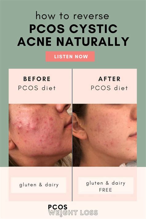 pcos symptoms acne