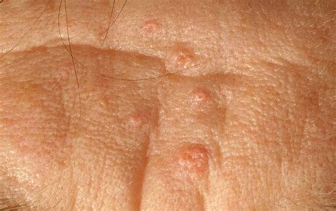 Sebaceous Glands - Pictures, Function, Types, Location - HubPages 