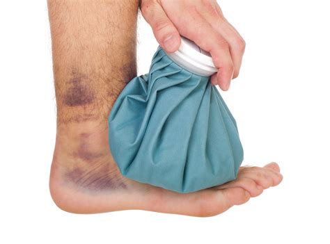 Does Icing Help Sprained Ankle at Bryan Riggs blog